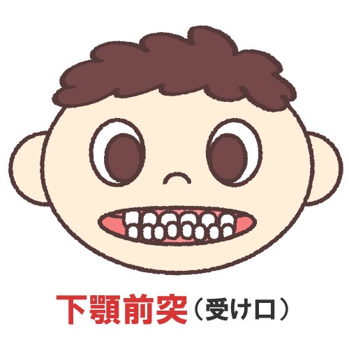 下顎前突(受け口)